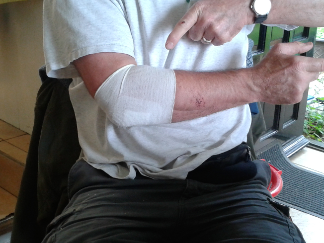 Poorly elbow!